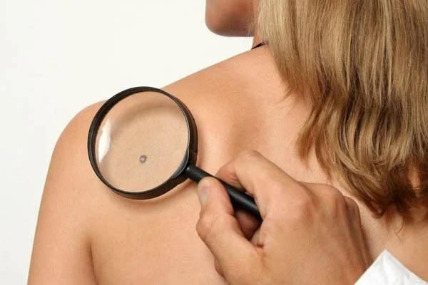 Акция по ранней диагностике злокачественных новообразований кожи